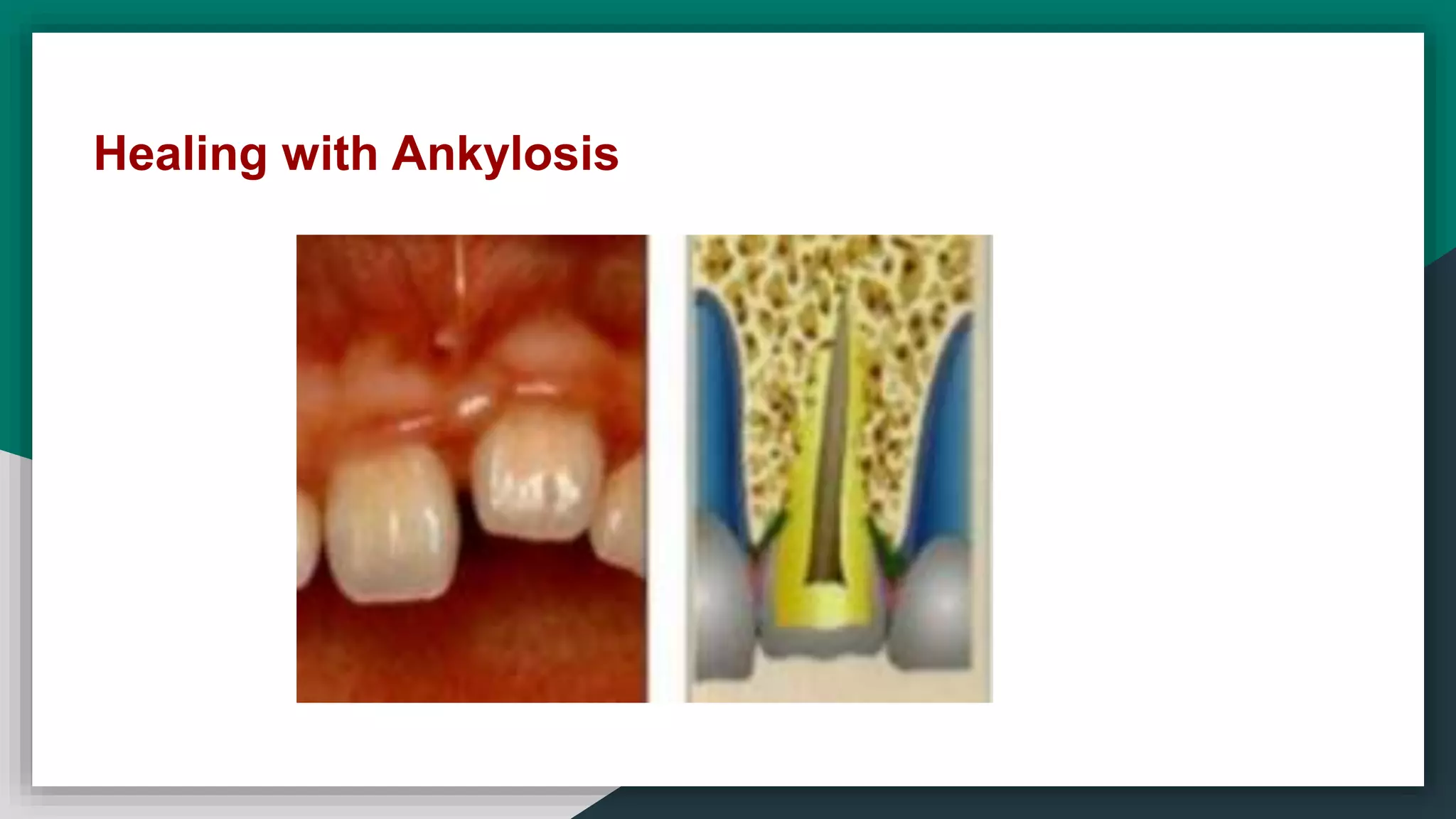 Healing with Ankylosis
 