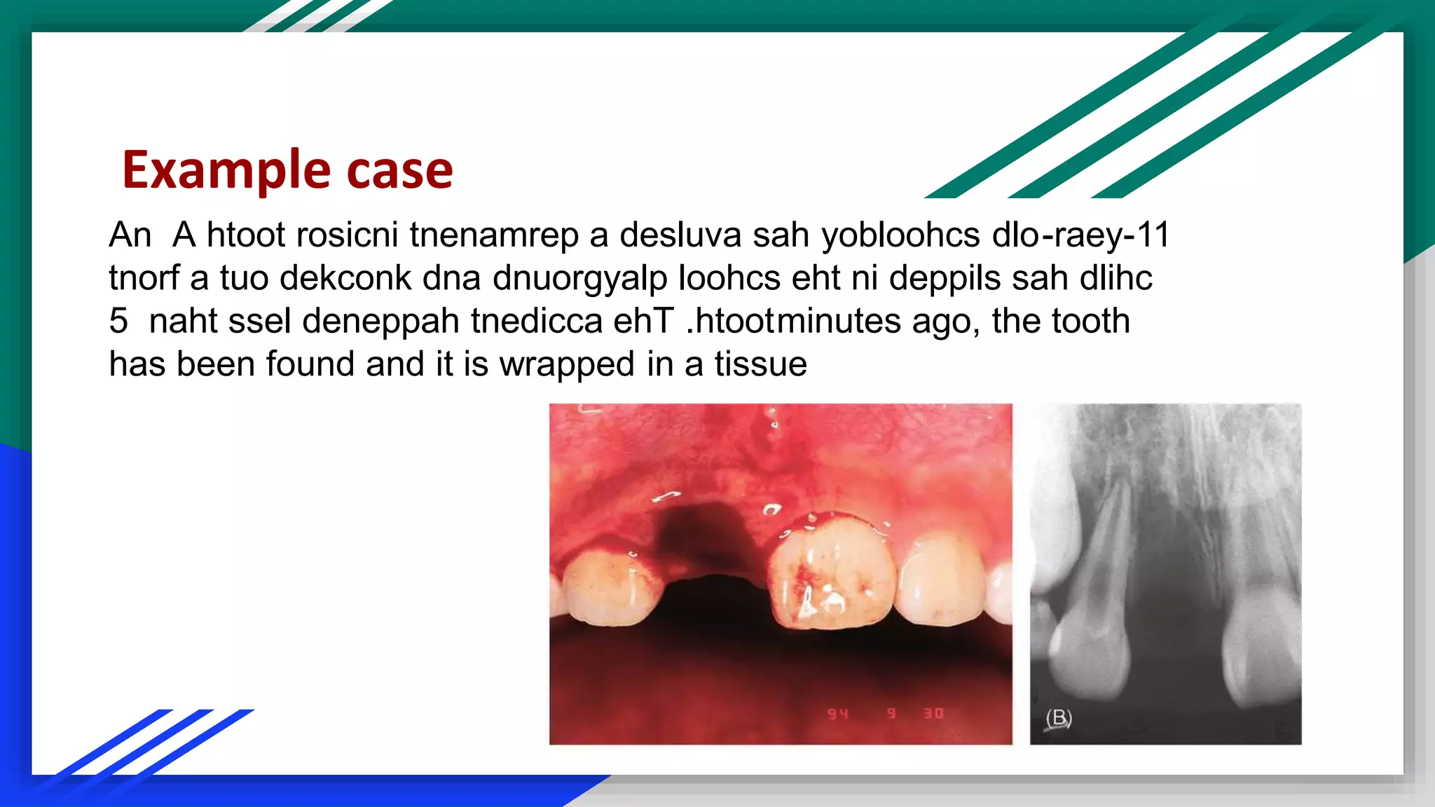 An 11-raey-A htoot rosicni tnenamrep a desluva sah yobloohcs dlo
tnorf a tuo dekconk dna dnuorgyalp loohcs eht ni deppils sah dlihc
naht ssel deneppah tnedicca ehT .htoot5 minutes ago, the tooth
has been found and it is wrapped in a tissue
Example case
 
