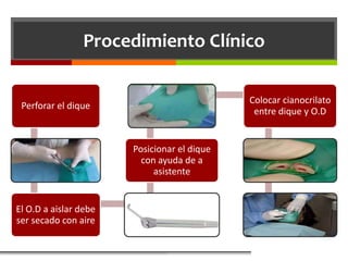 Procedimiento Clínico

                                             Colocar cianocrilato
 Perforar el dique
                                              entre dique y O.D


                       Posicionar el dique
                         con ayuda de a
                            asistente


El O.D a aislar debe
ser secado con aire
 