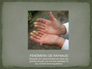 FENÔMENO DE RAYNAUD
(Causado por vasoconstrição de vasos san-
guíneos da pele, por provável alteração no
seu controle termoregulatório)
 