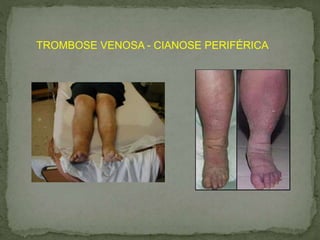 TROMBOSE VENOSA - CIANOSE PERIFÉRICA
 
