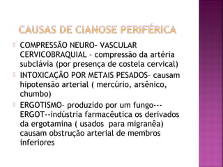 COMPRESSÃO NEURO- VASCULAR
CERVICOBRAQUIAL – compressão da artéria
subclávia (por presença de costela cervical)
 INTOXICAÇÃO POR METAIS PESADOS– causam
hipotensão arterial ( mercúrio, arsênico,
chumbo)
 ERGOTISMO– produzido por um fungo---
ERGOT--indústria farmacêutica os derivados
da ergotamina ( usados para migranêa)
causam obstrução arterial de membros
inferiores
 