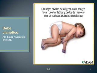 Por bajos niveles de
oxigeno.

M.S

4

 