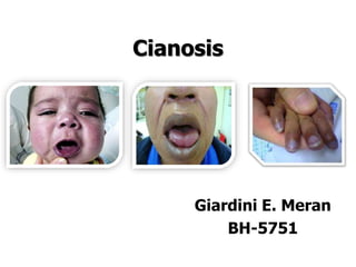 Cianosis
Giardini E. Meran
BH-5751
 