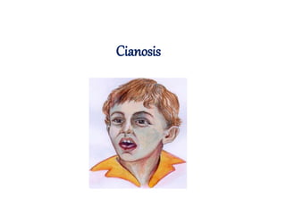 Cianosis
 