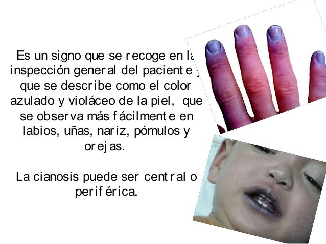 Cianosi