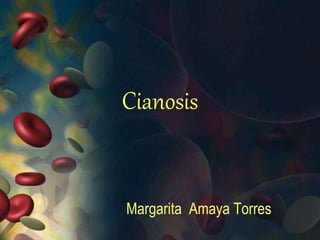 Cianosis 
Margarita Amaya Torres 
 