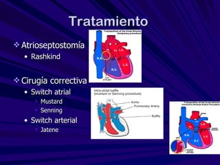 Conservative Rashkind Bas Cianóticas y flujo pulmonar aumentado | PPT