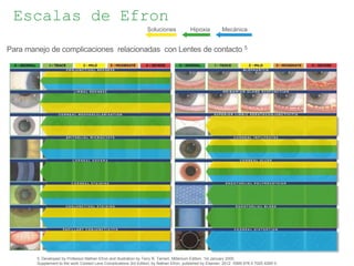 Soluciones Hipoxia Mecánica
Para manejo de complicaciones relacionadas con Lentes de contacto 5
5. Developed by Professor Nathan Efron and illustration by Terry R. Tarrant. Millenium Edition. 1st January 2000.
Supplement to the work Contact Lens Complications 3rd Edition, by Nathan Efron, published by Elsevier, 2012. ISBN 978 0 7020 4269 0.
Escalas de Efron
 