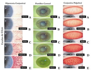 Conjuntiva PalpebralHiperemia Conjuntival Puntilleo Corneal
C CC
A AA
B BB
D DD
E EE
Normal Normal Normal
Incipiente Incipiente Incipiente
Media Media Media
Moderada Moderada Moderada
Severa Severa Severa
 
