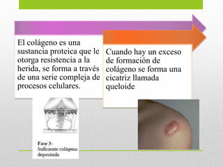 El colágeno es una
sustancia proteica que le
otorga resistencia a la
herida, se forma a través
de una serie compleja de
procesos celulares.
Cuando hay un exceso
de formación de
colágeno se forma una
cicatriz llamada
queloide
 