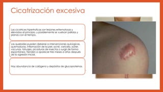 Cicatrización de heridas | PPTX