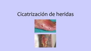Cicatrización de heridas
 