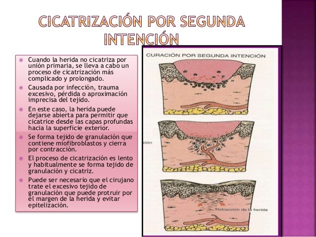 Cicatrización de heridas cirugia. maria asteria.