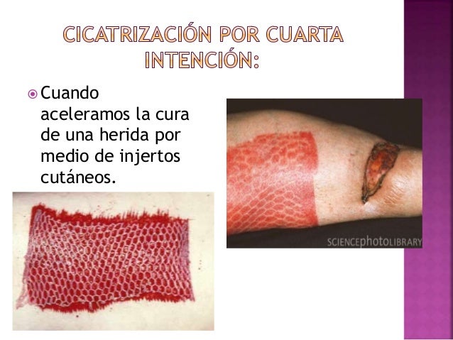 Cicatrización de heridas cirugia. maria asteria.