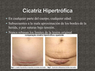  En cualquier parte del cuerpo, cualquier edad.
 Subsecuentes a la mala aproximación de los bordes de la
herida, o por suturas bajo tensión.
 Nunca rebasan los limites de la lesión original
 