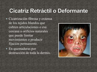  Cicatrización fibrosa y extensa
de los tejidos blandos que
cubren articulaciones o esa
cercana a orificios naturales
que puede limitar
movimientos o producir
fijación permanente.
 En quemaduras por
destrucción de toda la dermis.
 
