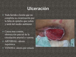  Toda herida o lesión que no
completa su cicatrización por
la falta de epitelio que cubra
y aislé del medio ambiente
 Causa mas común,
obstrucción parcial de la
circulación arterial o venosa.
 ARTERIAL: ulcera
isquémica
 VENOSA: ulcera por estasis
 