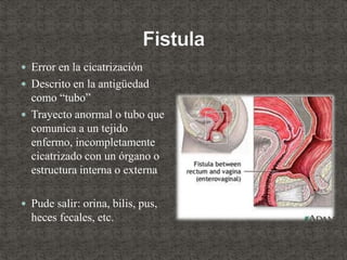  Error en la cicatrización
 Descrito en la antigüedad
como “tubo”
 Trayecto anormal o tubo que
comunica a un tejido
enfermo, incompletamente
cicatrizado con un órgano o
estructura interna o externa
 Pude salir: orina, bilis, pus,
heces fecales, etc.
 