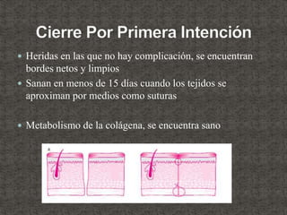  Heridas en las que no hay complicación, se encuentran
bordes netos y limpios
 Sanan en menos de 15 días cuando los tejidos se
aproximan por medios como suturas
 Metabolismo de la colágena, se encuentra sano
 