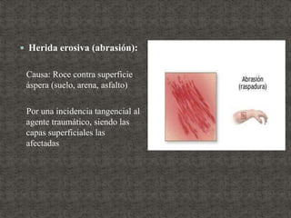  Herida erosiva (abrasión):
Causa: Roce contra superficie
áspera (suelo, arena, asfalto)
Por una incidencia tangencial al
agente traumático, siendo las
capas superficiales las
afectadas
 