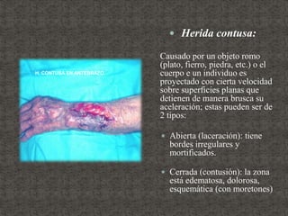  Herida contusa:
Causado por un objeto romo
(plato, fierro, piedra, etc.) o el
cuerpo e un individuo es
proyectado con cierta velocidad
sobre superficies planas que
detienen de manera brusca su
aceleración; estas pueden ser de
2 tipos:
 Abierta (laceración): tiene
bordes irregulares y
mortificados.
 Cerrada (contusión): la zona
está edematosa, dolorosa,
esquemática (con moretones)
H. CONTUSA EN ANTEBRAZO
 