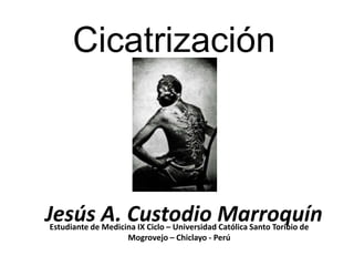 Cicatrización



Jesús A. Custodio Marroquín
Estudiante de Medicina IX Ciclo – Universidad Católica Santo Toribio de
                    Mogrovejo – Chiclayo - Perú
 
