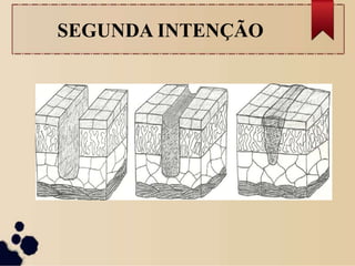 SEGUNDA INTENÇÃO
 