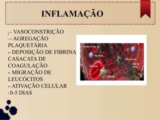 INFLAMAÇÃO
l
l - VASOCONSTRIÇÃO
l - AGREGAÇÃO
PLAQUETÁRIA
l- DEPOSIÇÃO DE FIBRINA/
CASACATA DE
COAGULAÇÃO
l- MIGRAÇÃO DE
LEUCÓCITOS
l- ATIVAÇÃO CELULAR
l 0-5 DIAS
 