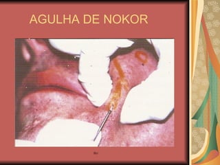 AGULHA DE NOKOR 