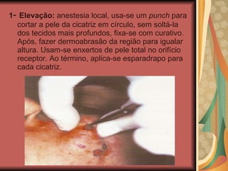 1 -  Elevação:  anestesia local, usa-se um  punch  para cortar a pele da cicatriz em círculo, sem soltá-la dos tecidos mais profundos, fixa-se com curativo. Após, fazer dermoabrasão da região para igualar altura. Usam-se enxertos de pele total no orifício receptor. Ao término, aplica-se esparadrapo para cada cicatriz. 