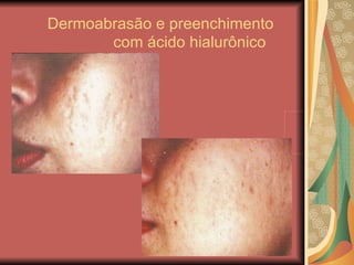 Dermoabrasão e preenchimento    com ácido hialurônico   