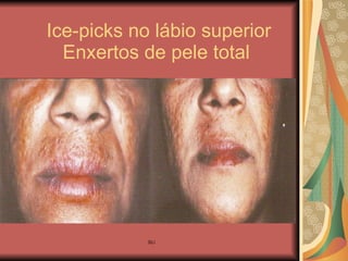 Ice-picks no lábio superior   Enxertos de pele total 