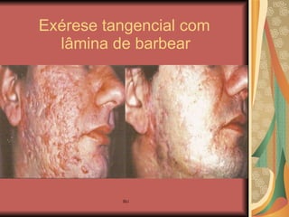 Exérese tangencial com    lâmina de barbear 