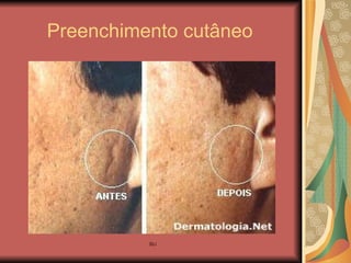 Preenchimento cutâneo 