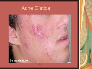 Acne Cística 