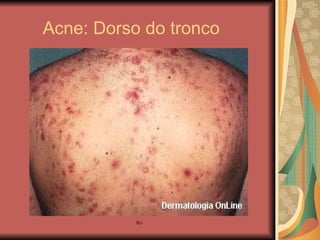 Acne: Dorso do tronco 