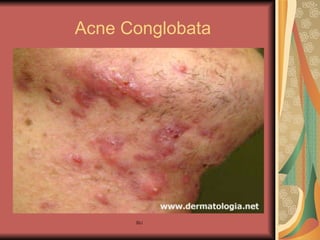 Acne Conglobata 
