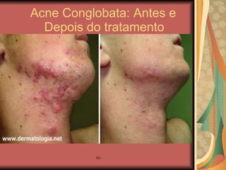 Acne Conglobata: Antes e    Depois do tratamento 