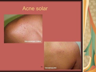 Acne solar 