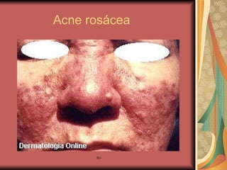 Acne rosácea 