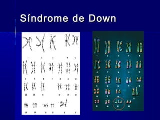 Síndrome de DownSíndrome de Down
 