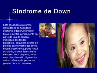 Síndrome de DownSíndrome de Down
Está associada a algumas
dificuldades de habilidade
cognitiva e desenvolvimento
físico e mental. achatamento da
parte de trás da cabeça,
inclinação das fendas
palpebrais, pequenas dobras de
pele no canto interno dos olhos,
língua proeminente, ponte nasal
achatada, orelhas ligeiramente
menores, boca pequena, tônus
muscular diminuído, ligamentos
soltos, mãos e pés pequenos,
pele na nuca em excesso.
 