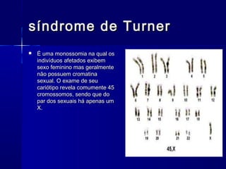 síndrome de Turnersíndrome de Turner
 É uma monossomia na qual osÉ uma monossomia na qual os
indivíduos afetados exibemindivíduos afetados exibem
sexo feminino mas geralmentesexo feminino mas geralmente
não possuem cromatinanão possuem cromatina
sexual. O exame de seusexual. O exame de seu
cariótipo revela comumente 45cariótipo revela comumente 45
cromossomos, sendo que docromossomos, sendo que do
par dos sexuais há apenas umpar dos sexuais há apenas um
X.X.
 