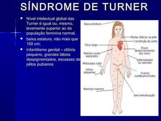 SÍNDROME DE TURNERSÍNDROME DE TURNER
 Nível intelectual global dasNível intelectual global das
Turner é igual ou, mesmo,Turner é igual ou, mesmo,
levemente superior ao dalevemente superior ao da
população feminina normal.população feminina normal.
 baixa estatura, não mais quebaixa estatura, não mais que
150 cm;150 cm;
 Infantilismo genital – clitórisInfantilismo genital – clitóris
pequeno, grandes lábiospequeno, grandes lábios
despigmentados, escassez dedespigmentados, escassez de
pêlos pubianospêlos pubianos
 