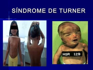 SÍNDROME DE TURNERSÍNDROME DE TURNER
 
