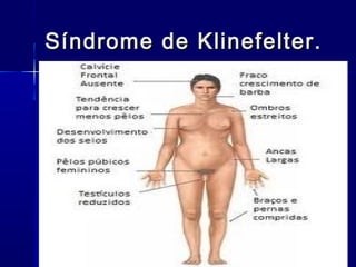 Síndrome de Klinefelter.Síndrome de Klinefelter.
 