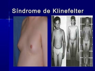 Síndrome de KlinefelterSíndrome de Klinefelter
 
