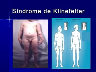 Síndrome de KlinefelterSíndrome de Klinefelter
 