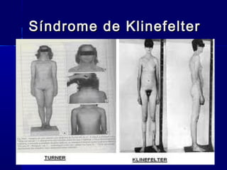 Síndrome de KlinefelterSíndrome de Klinefelter
 